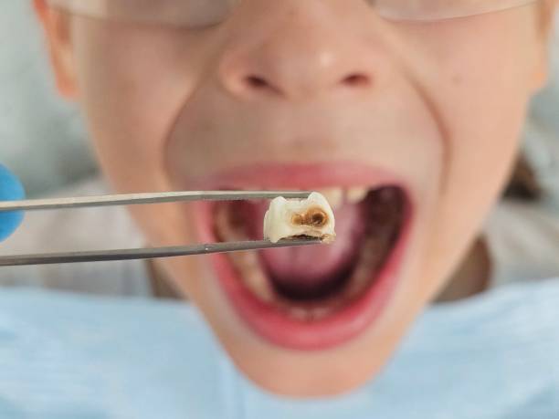 Best Emergency Treatment for Dental Infections or Abscesses in Morrow, GA